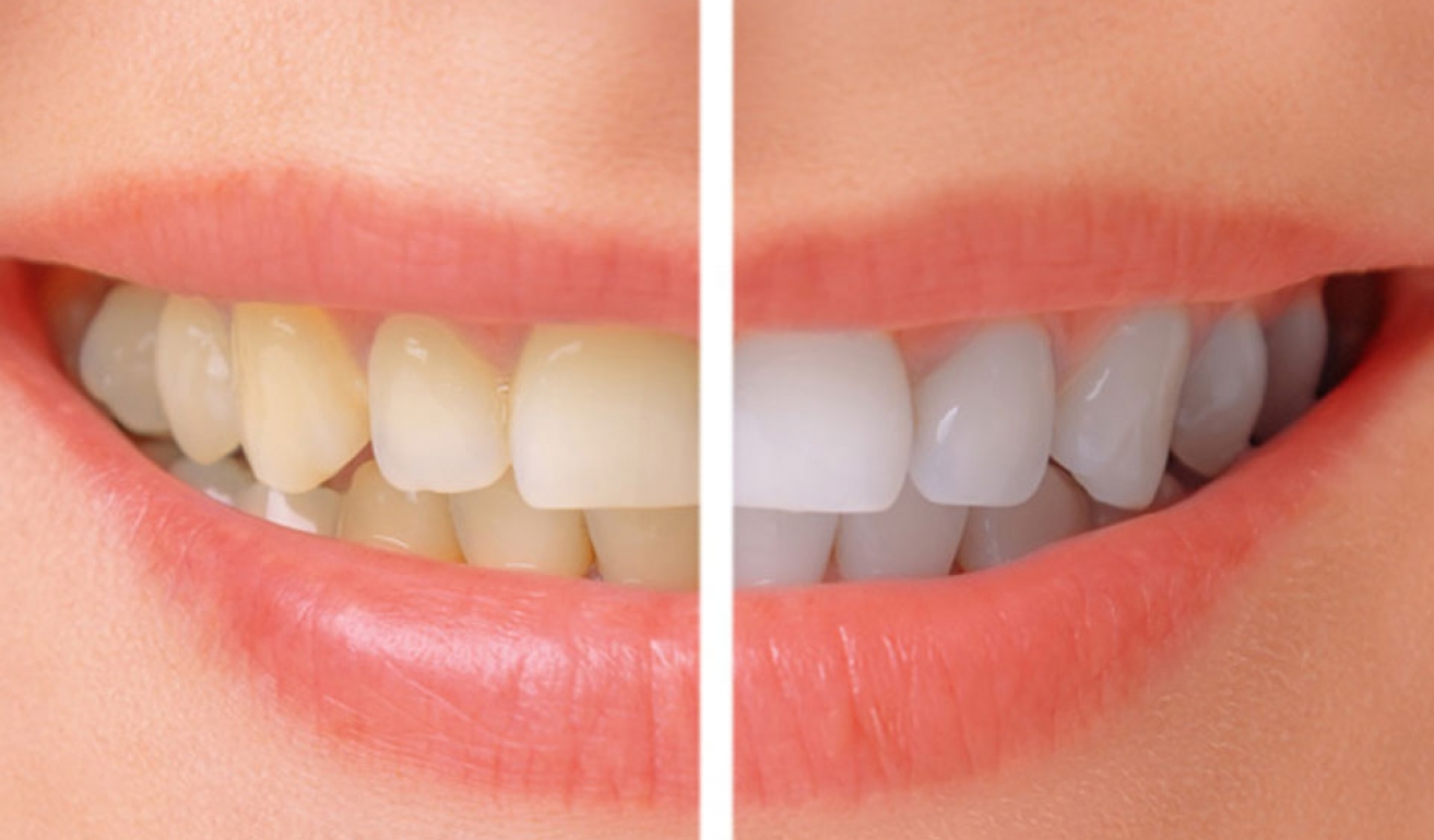 tennene blir misfargede eller flekkete
